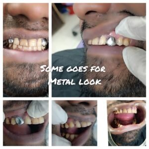 Metal Implants