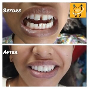 gap filling