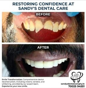 A picture showing before after of front teeth deformity. The picture shows balancing and whitening the teeth after procedcure.